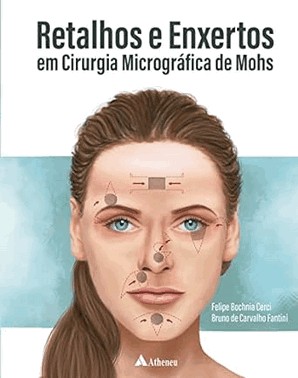 Retalhos E Enxertos Em Cirurgia Micrografica De Mohs - 01Ed/22