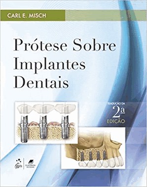 Protese Sobre Implantes Dentais