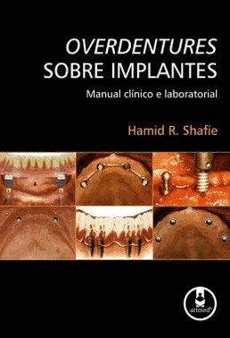 Overdentures Sobre Implantes